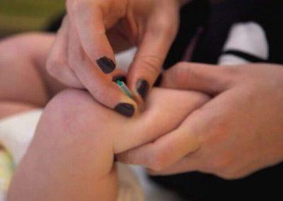 ¿Necesita su bebé acupuntura? Lo que debe saber antes de decidir